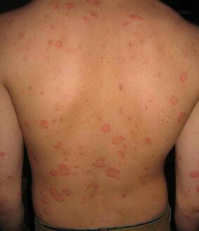 psoriasis en la espalda