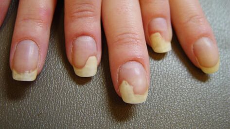Manchas blancas en las uñas debido a la psoriasis.