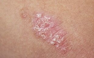 causas de la psoriasis