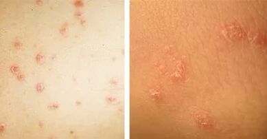 principales manifestaciones de la psoriasis