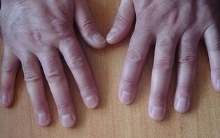 síntomas de psoriasis en la etapa inicial