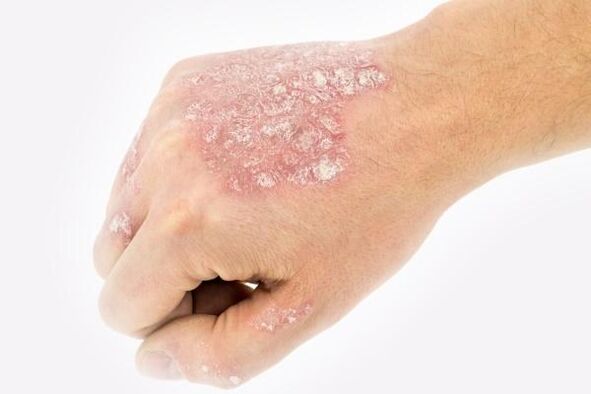 Mecanismo de desarrollo de la psoriasis en las manos.