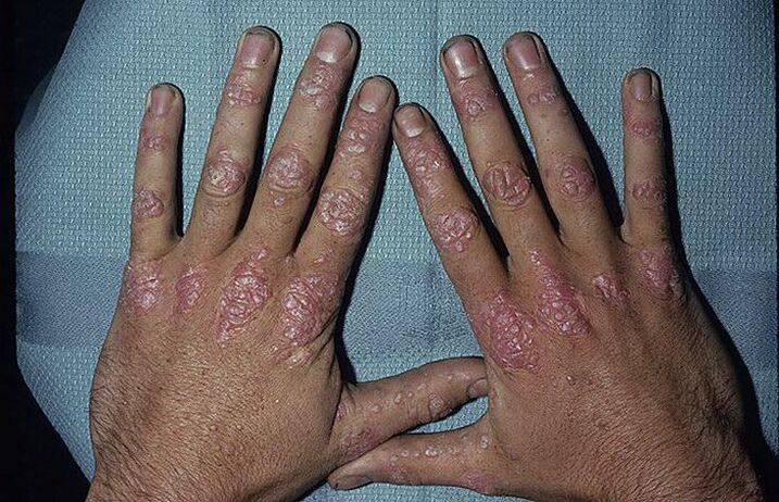 Razones para el desarrollo de psoriasis en las manos.
