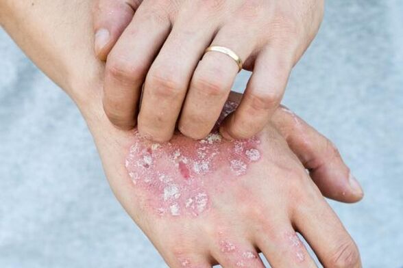 Síntomas característicos de la psoriasis en las manos.