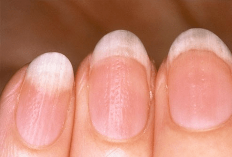 psoriasis en las uñas