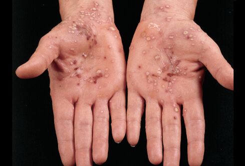 ¿Cómo se ve la psoriasis en las palmas de las manos 