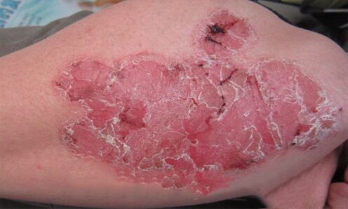 ¿Cómo se ve la psoriasis pustulosa en la piel 