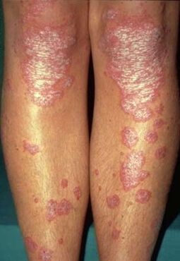 Manifestaciones de psoriasis en las piernas. 