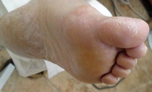 Psoriasis en el pie