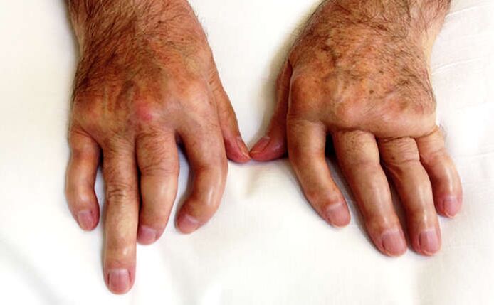 Artritis mutilante en psoriasis