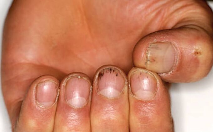 Hemorragia debajo de las uñas con psoriasis. 