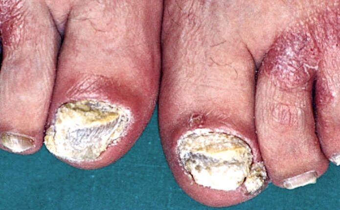 Hiperqueratosis subungueal grave y placas psoriásicas en los dedos de los pies