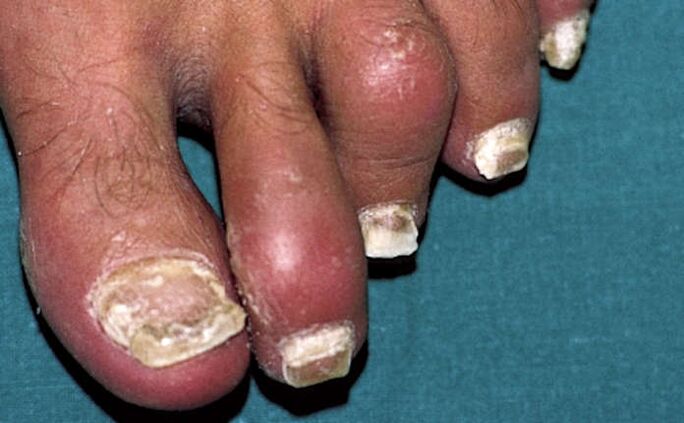 Psoriasis con afectación de las uñas e inflamación de las articulaciones (artritis) de los dedos de los pies