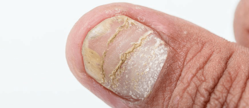 forma aguda de complicaciones de la psoriasis en la uña