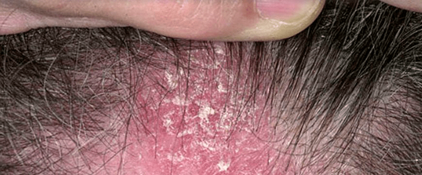 lesiones cutáneas en el cuero cabelludo con psoriasis