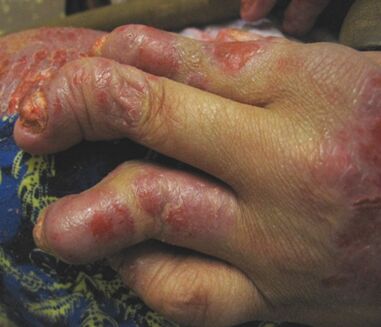 psoriasis desatendida en las manos