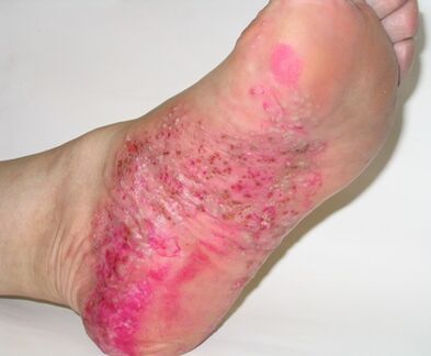 psoriasis en el pie